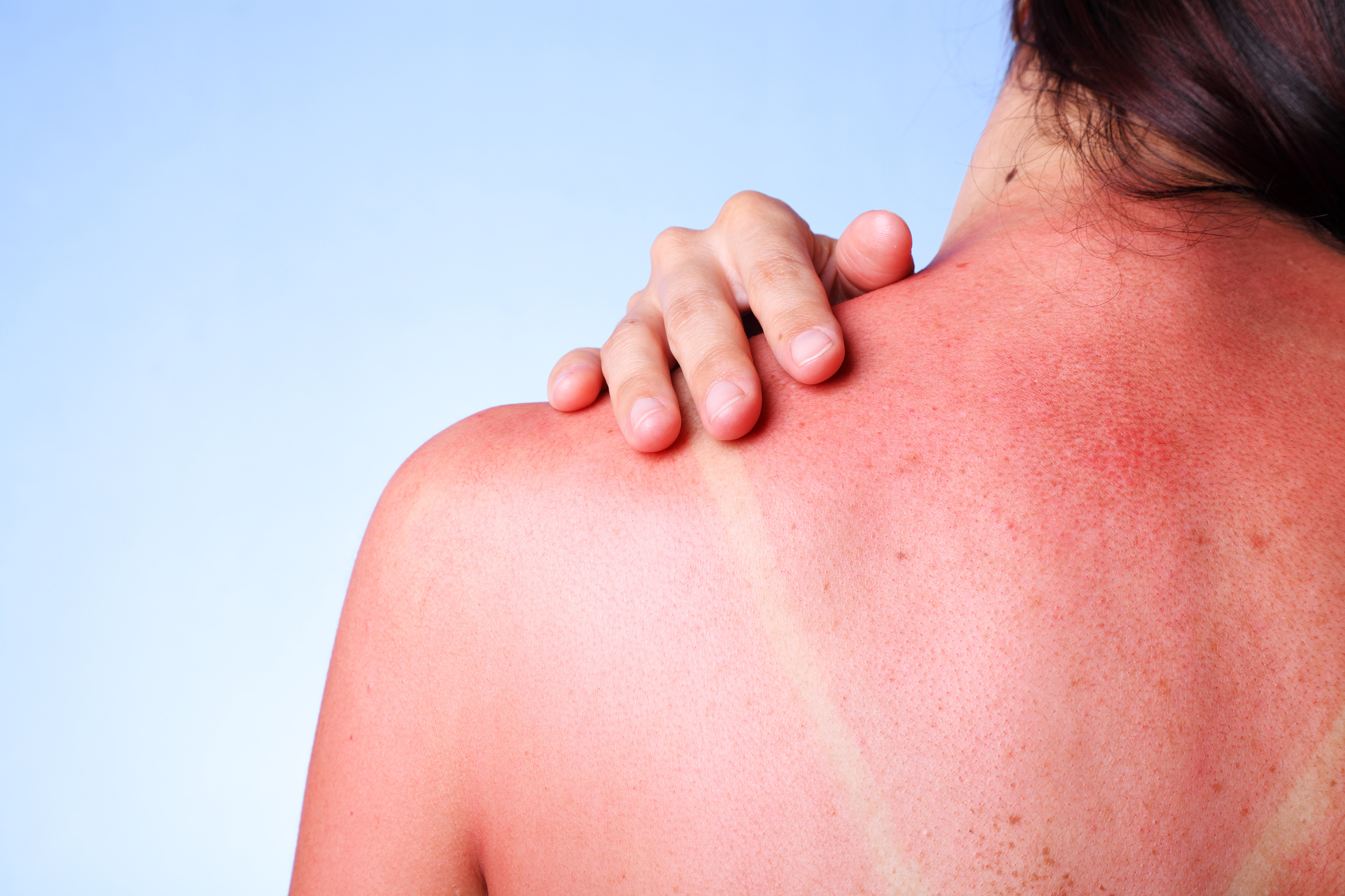 Sunburn & Safety from Sunlight and Heat