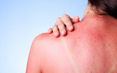 Sunburn & Safety from Sun...